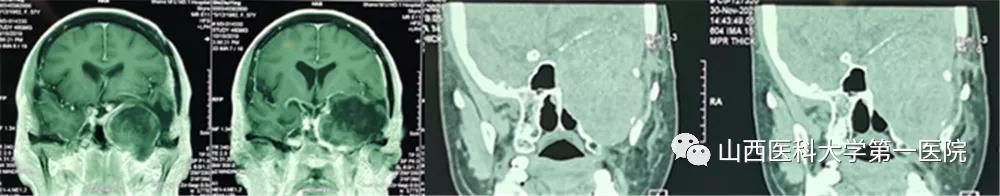 山西医科大学第一医院手术案例,山西医科大第一医院外科