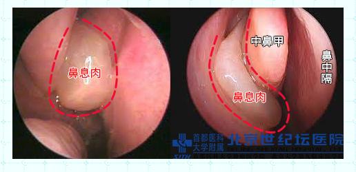 鼻炎手术怎么做要把鼻子切开吗,鼻炎手术的全过程