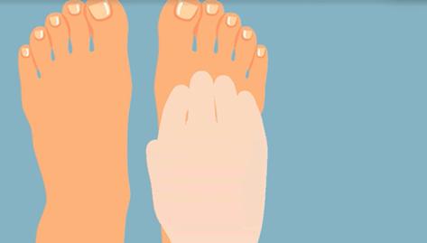 一走路脚趾甲痛,甲沟炎拔完脚趾甲很疼怎么办