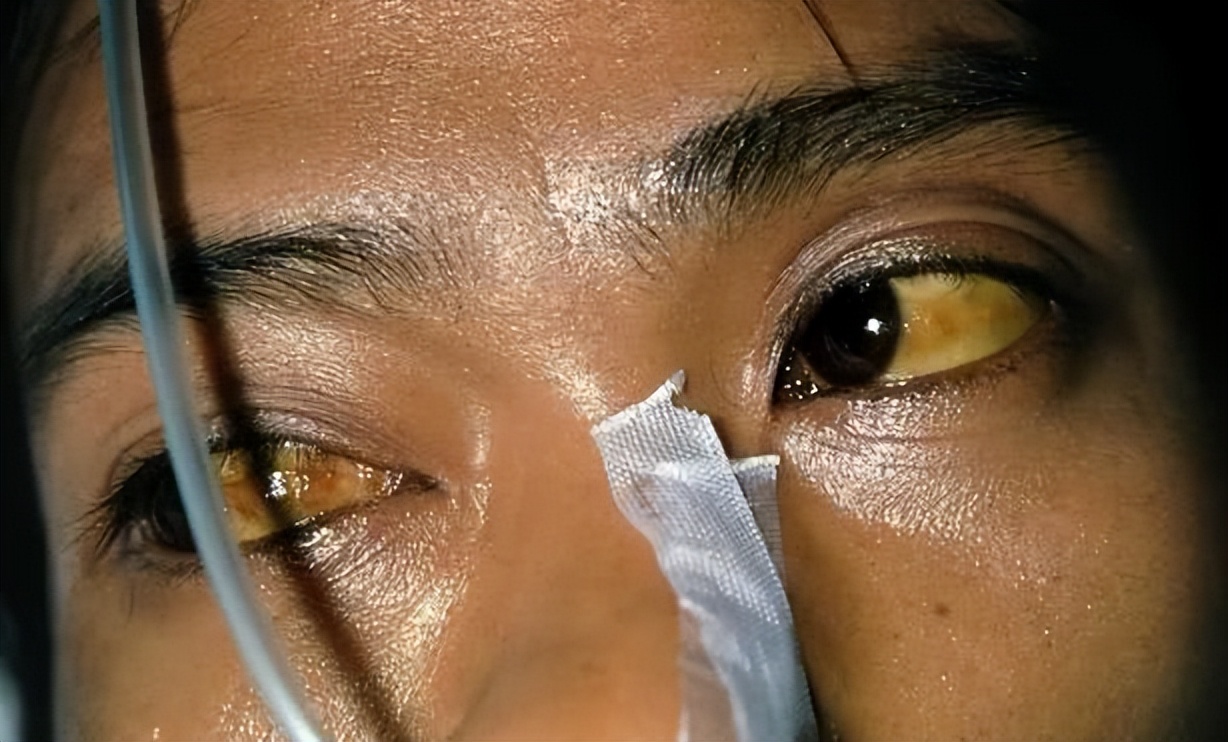 体检查出总胆红素高是什么原因,体检显示胆红素偏高有什么危害