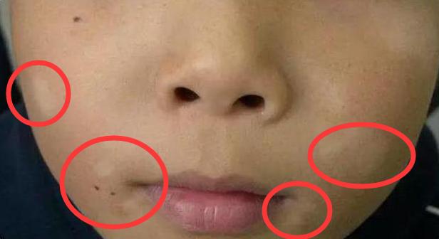 孩子脸上长白斑是怎么回事？是白癜风吗？要让娃吃“打虫药”吗？