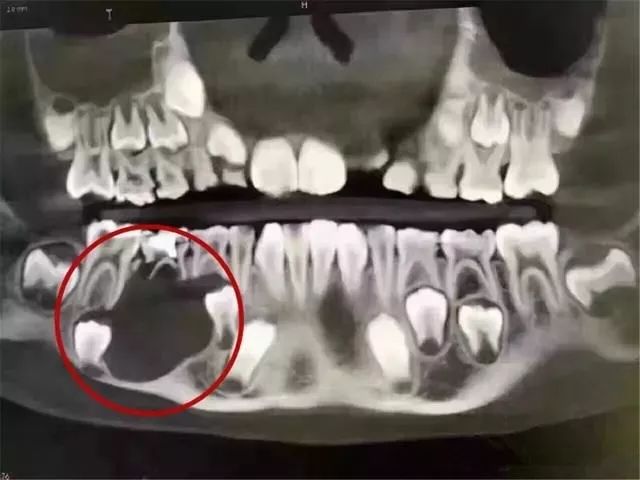 乳牙坏了能让你破费六位数，你信吗？