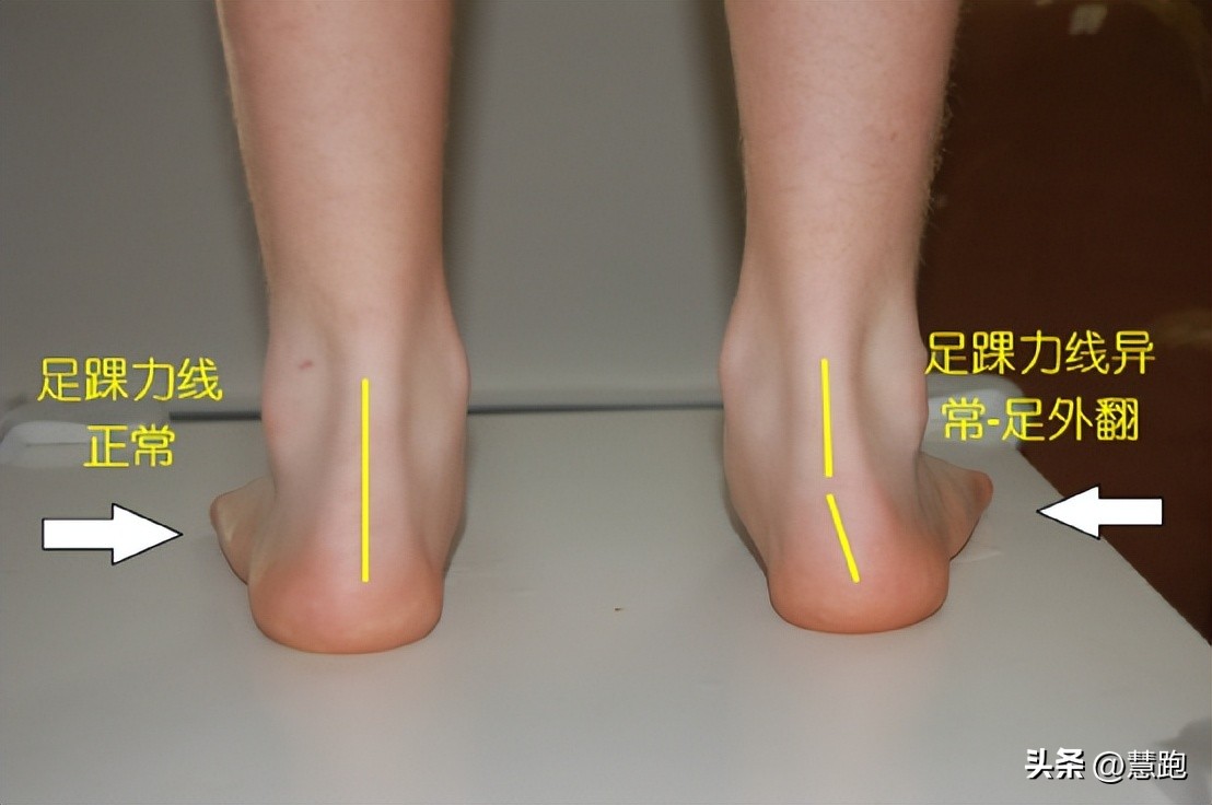 这类顽固性的跑步伤痛最让跑者头疼：4种有效康复方法教你破解