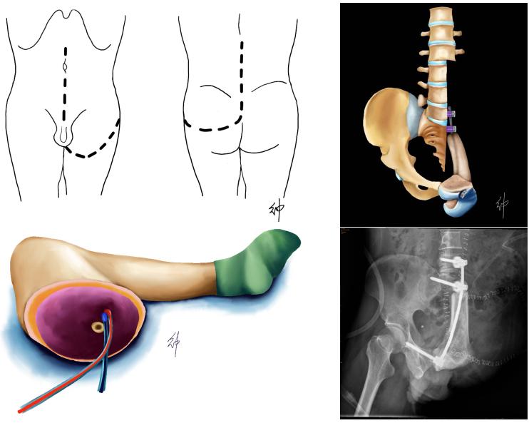 骨肿瘤骨盆重建手术,骨肿瘤多处转移还能治愈吗