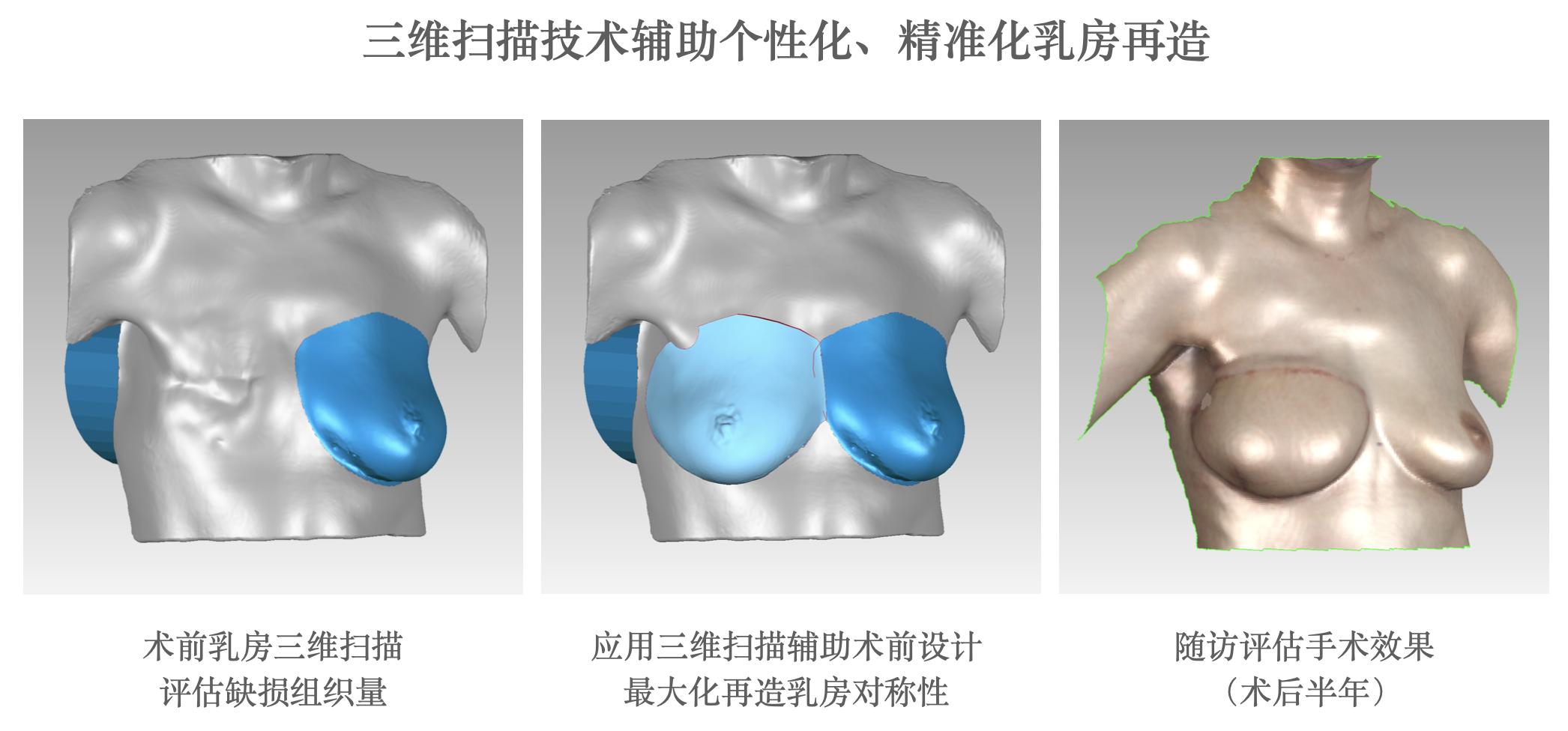乳腺癌一期假体再造术,乳腺癌乳房再造术
