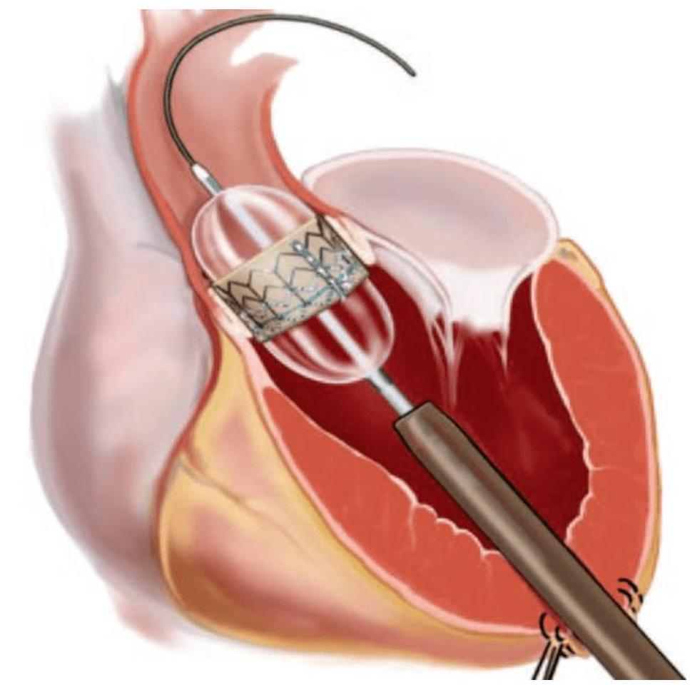 急性心肌梗塞能治好吗,急性心肌梗塞算不算重大疾病