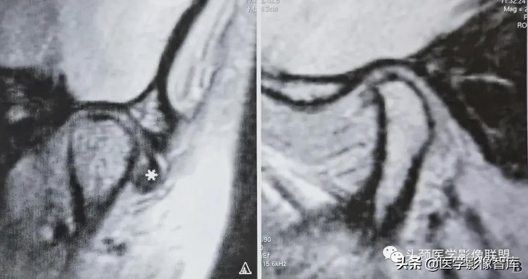 颞下颌关节移位怎么处理,颞下颌关节盘变形怎么治疗