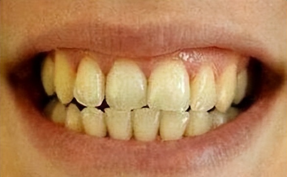 牙齿没矫正前可以去洗牙美白吗,牙齿美白可以戴牙套吗