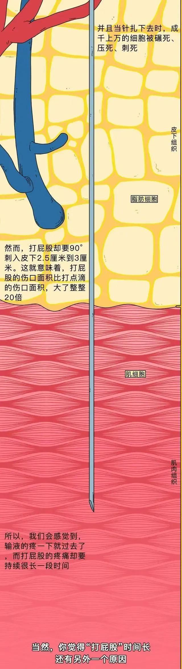 童年噩梦——“屁股针”，为啥那么痛？「漫画揭秘