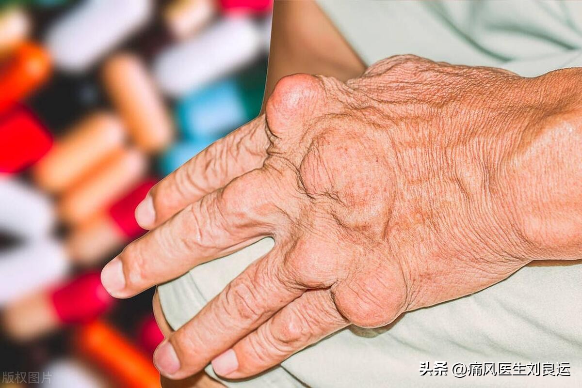 尿酸高是痛风好还是不痛风好,尿酸高有一个关节痛算是痛风吗