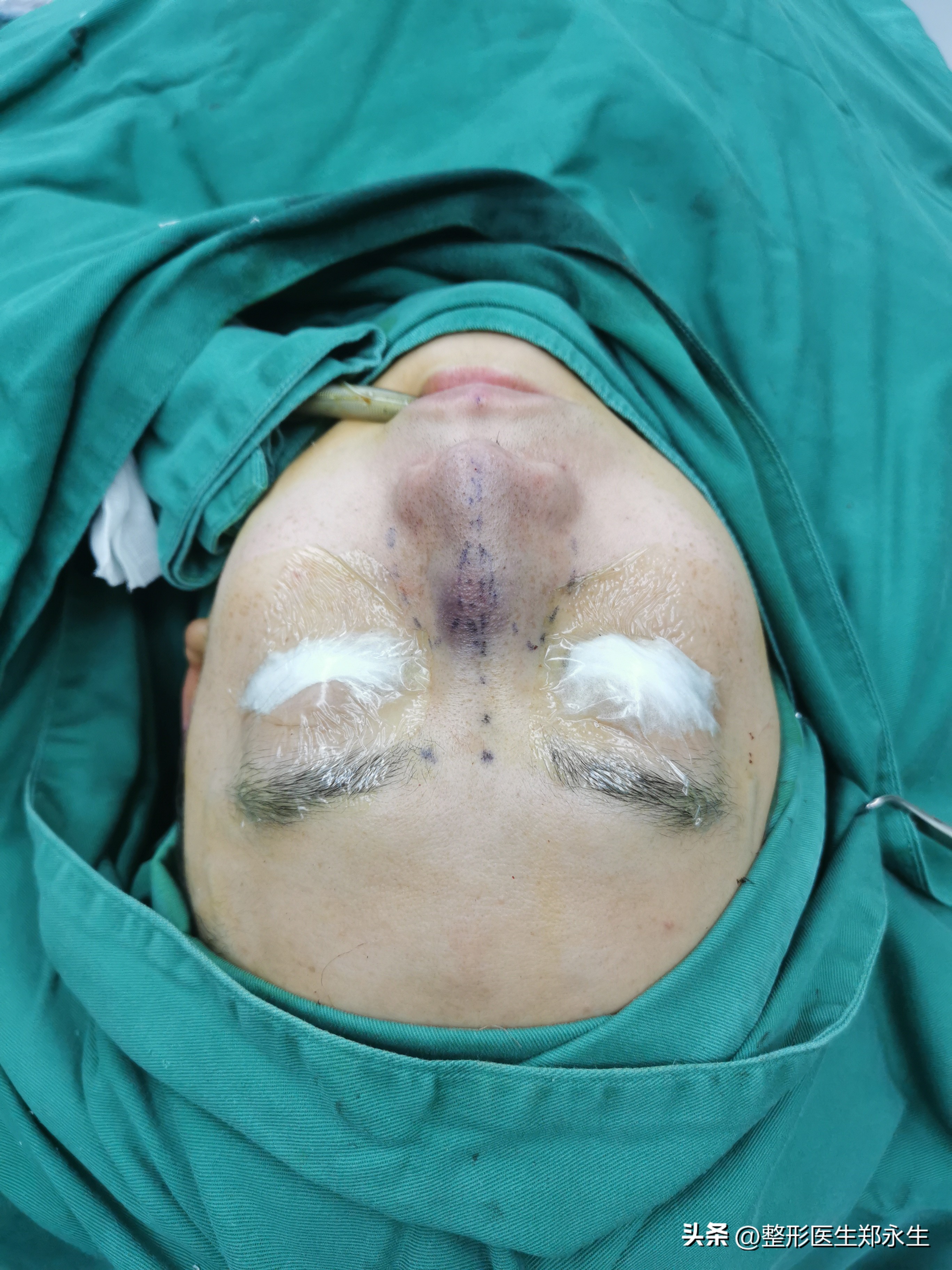 歪鼻子如何整形,歪鼻手术案例男