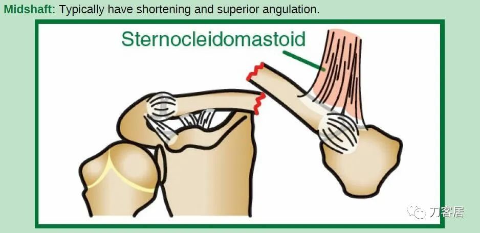 儿童锁骨骨折保守治疗的弊端,锁骨粉碎骨折错位不处理会愈合吗