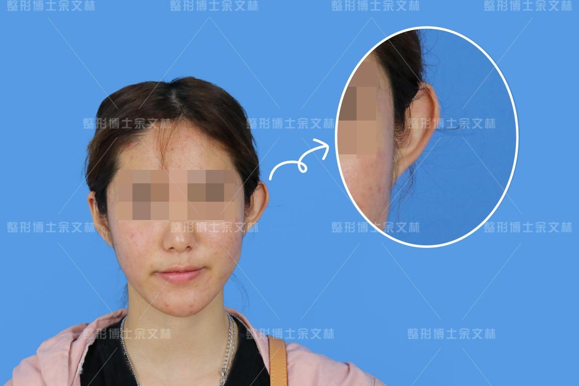 轻微招风耳怎么矫正,招风耳畸形是先天还是后天