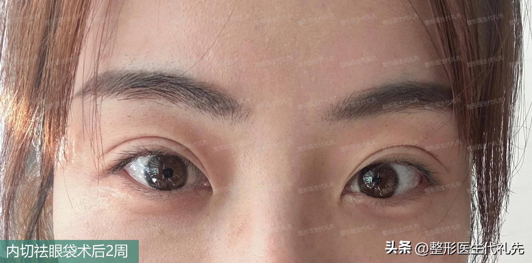 眼袋内切手术后眼袋不对称,年轻人内切眼袋手术恢复期7天图