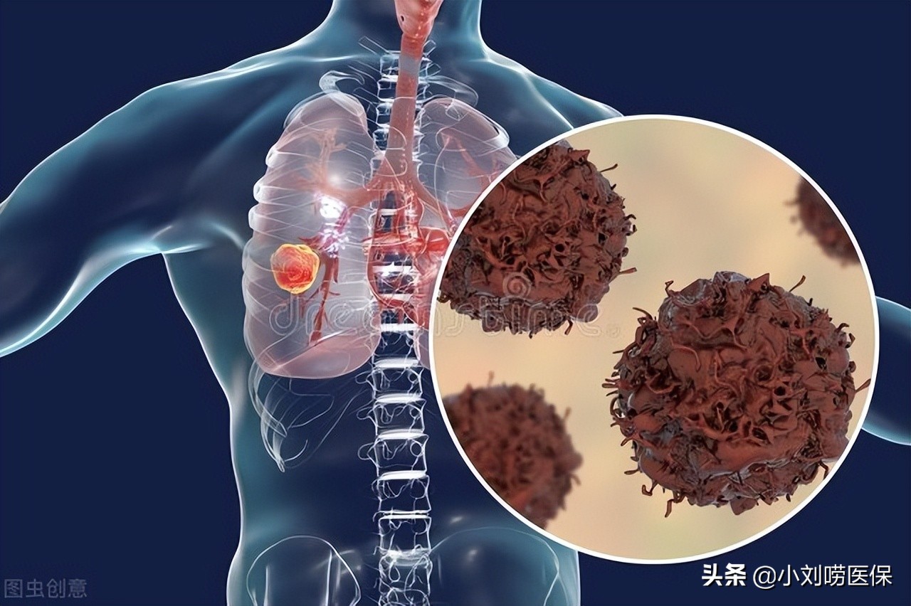 肺癌晚期可以申请哪些报销,肺癌医疗报销完能申请大病救助吗