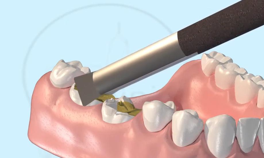 拔牙一周牙龈隐隐疼是干槽症吗,为什么拔牙后三天就排除干槽症