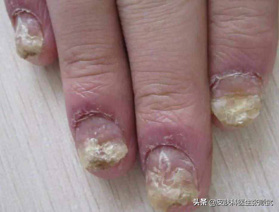 银屑病被误诊为水痘,银屑病误诊为湿疹