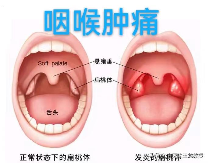 喉咙有痰什么中药泡茶喝有效,喉咙有痰有时咳嗽中药调理