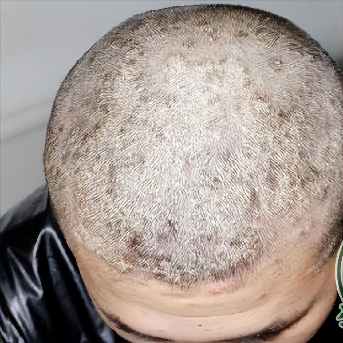 头皮长疙瘩怎么回事怎么解决,头皮上长疙瘩怎么治疗彻底