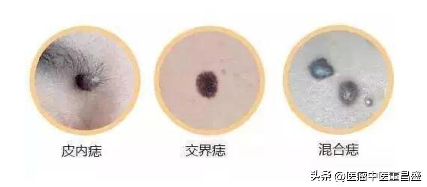 健康科普黑色素瘤到底是什么,曝张恒远离世细节