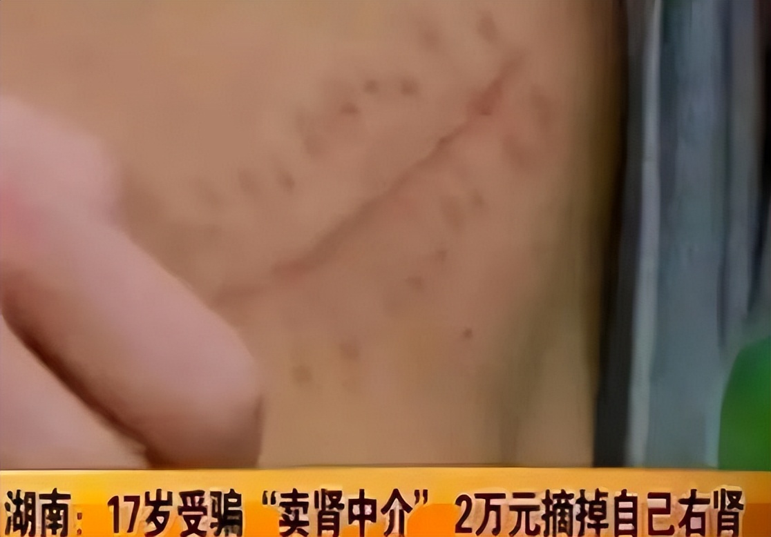 高中生卖肾换苹果手机事件,高中生卖肾换苹果手机的后果