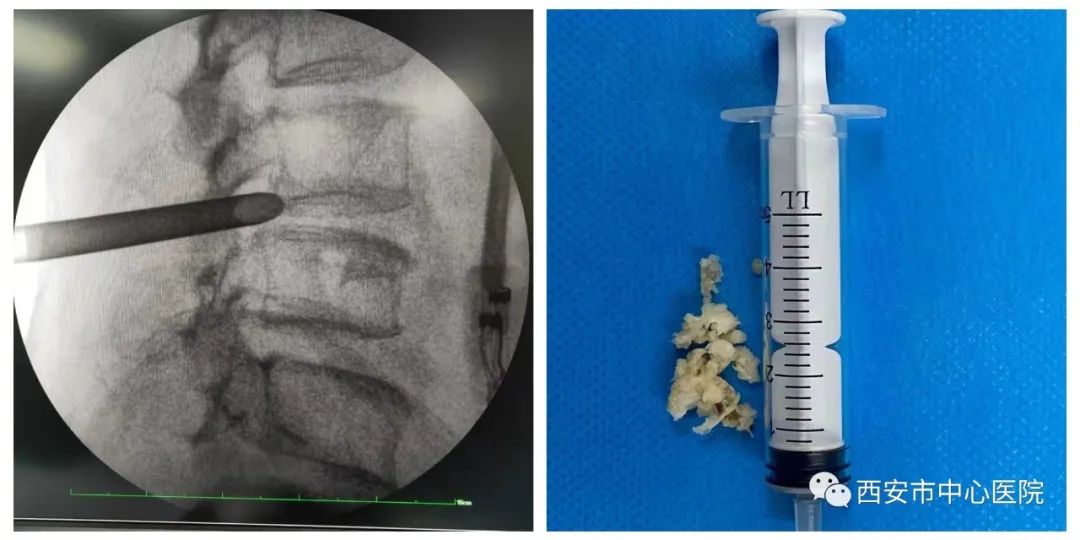 椎间孔镜治疗腰间盘突出视频,腰椎间盘突出做椎间孔镜腰胀痛