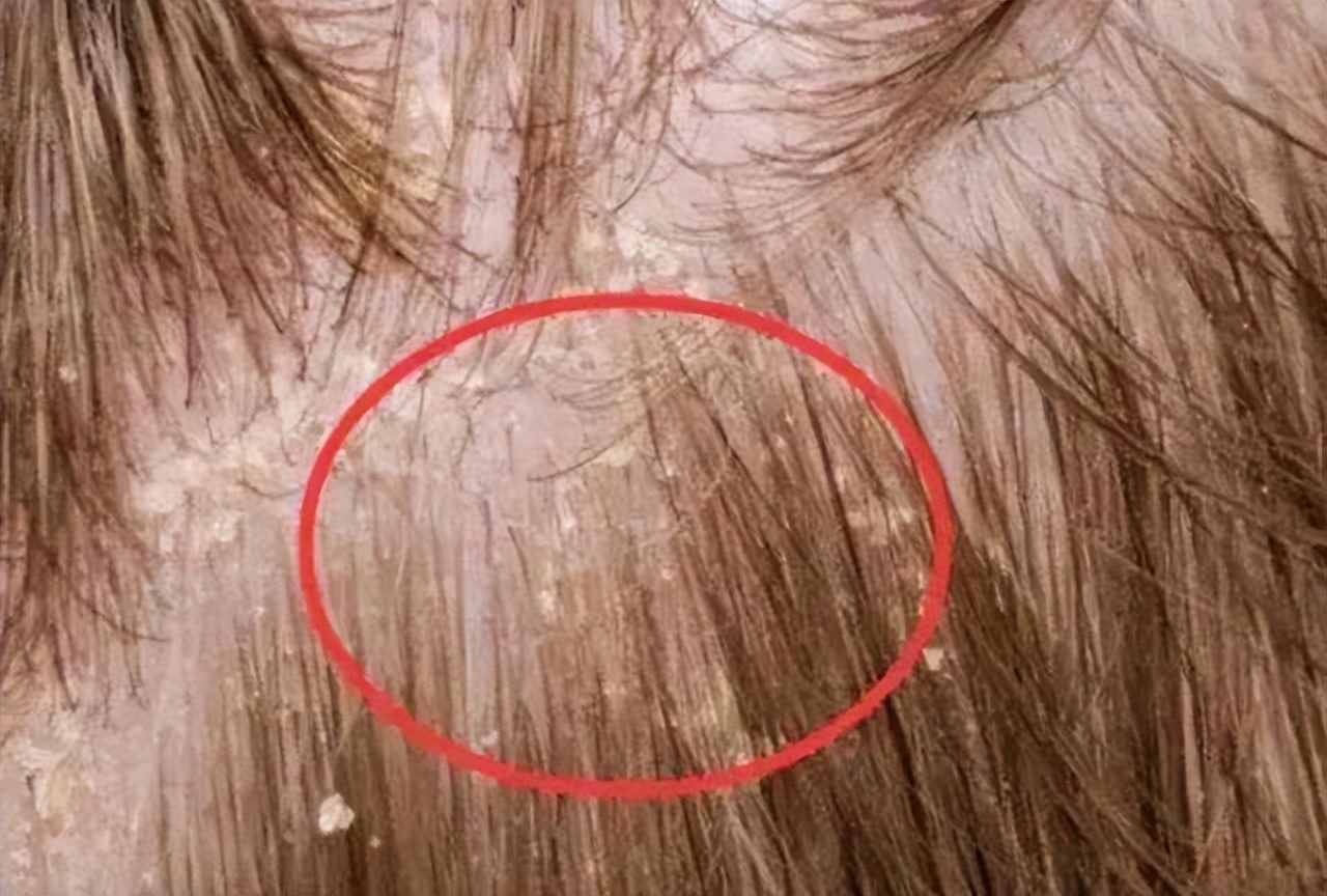 头皮上长红疙瘩脓包头皮屑特别多,头皮总是长疙瘩或脓包是什么原因