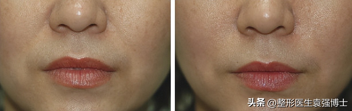 法令纹重就丑吗,法令纹丑了怎么办