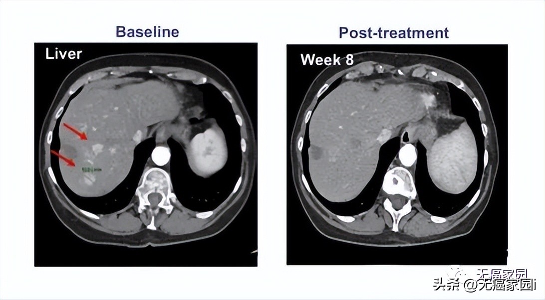 CAR-T疗法全球首例,car-t疗法和nk疗法