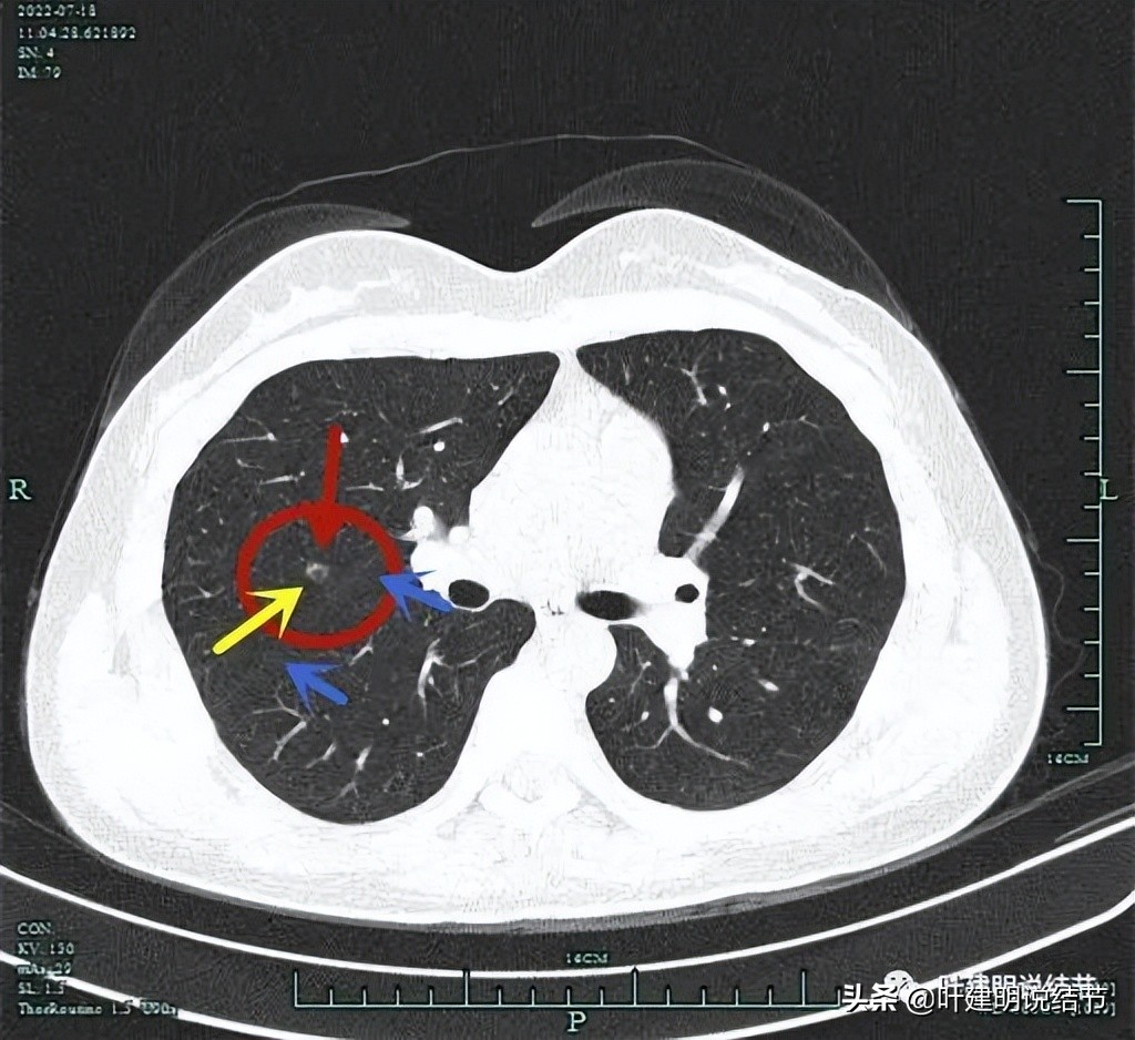 2cm的肺磨玻璃结节如何处理最合适,年轻女人磨玻璃结节