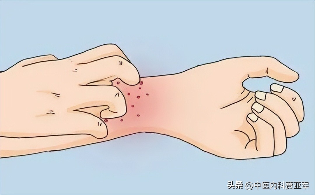 肛门潮湿瘙痒漏少量屎吃什么药好,肛门潮湿瘙痒能吃盐酸依匹斯汀吗