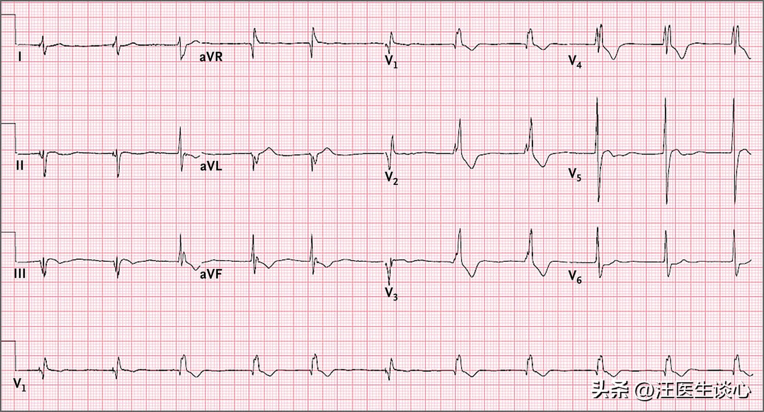 右束支完全性传导阻滞是心脏病,体检发现右束支传导阻滞