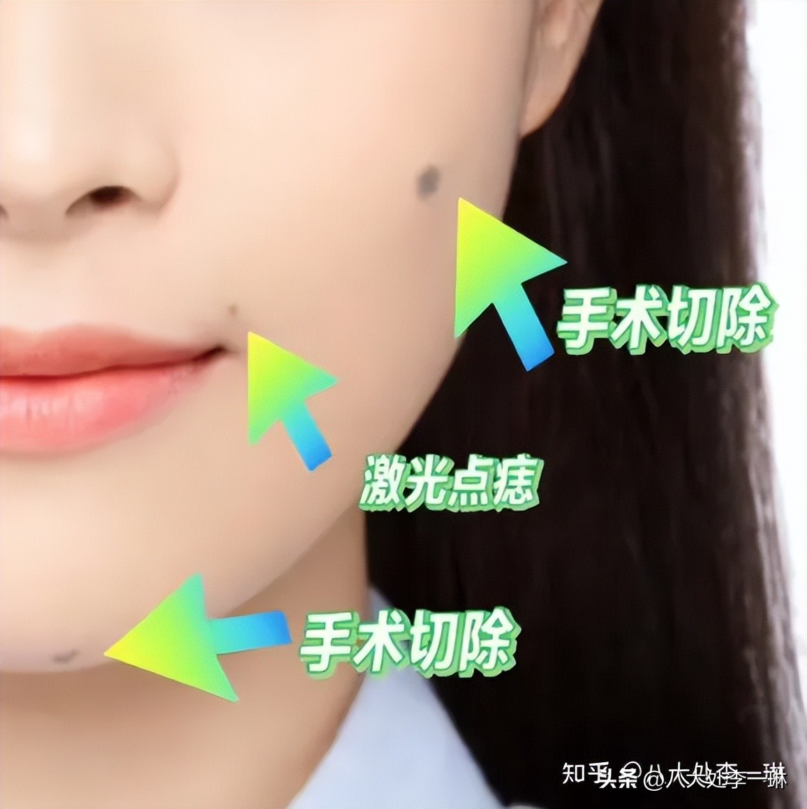 色素痣的形成原因及去除方法,无色素痣和色素痣的区别