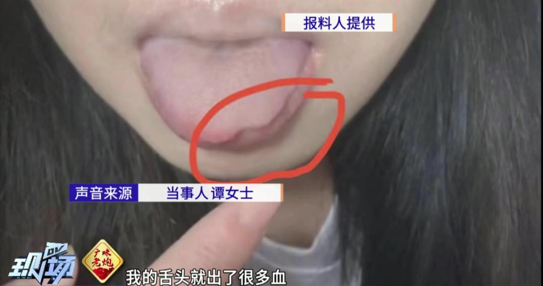 女子吃菠萝舌头少了一块,女子吃菠萝嘴巴出血