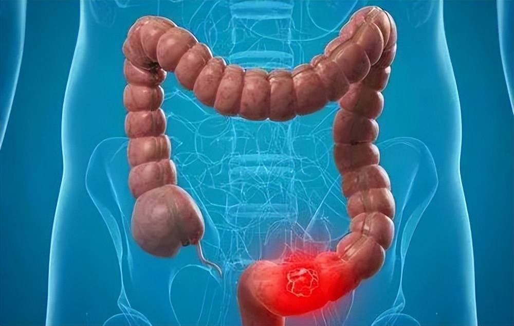 刚吃完饭就想排便大便稀粘液,每天吃完三餐饭就排便是怎么回事