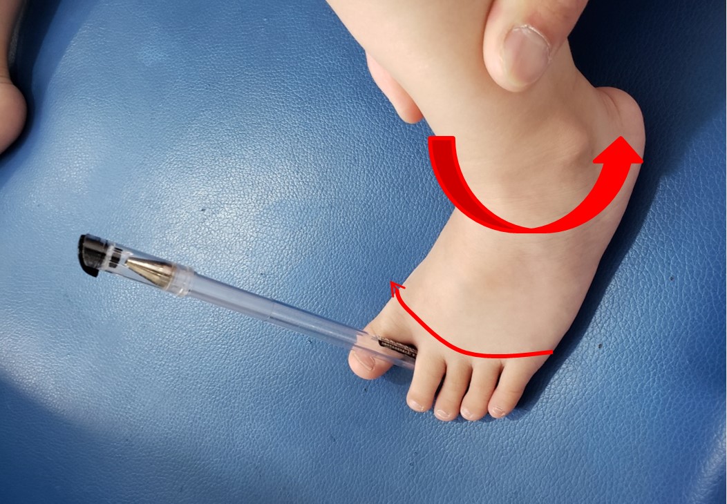 成人初期扁平足可以干预吗,两岁足外翻扁平足康复训练