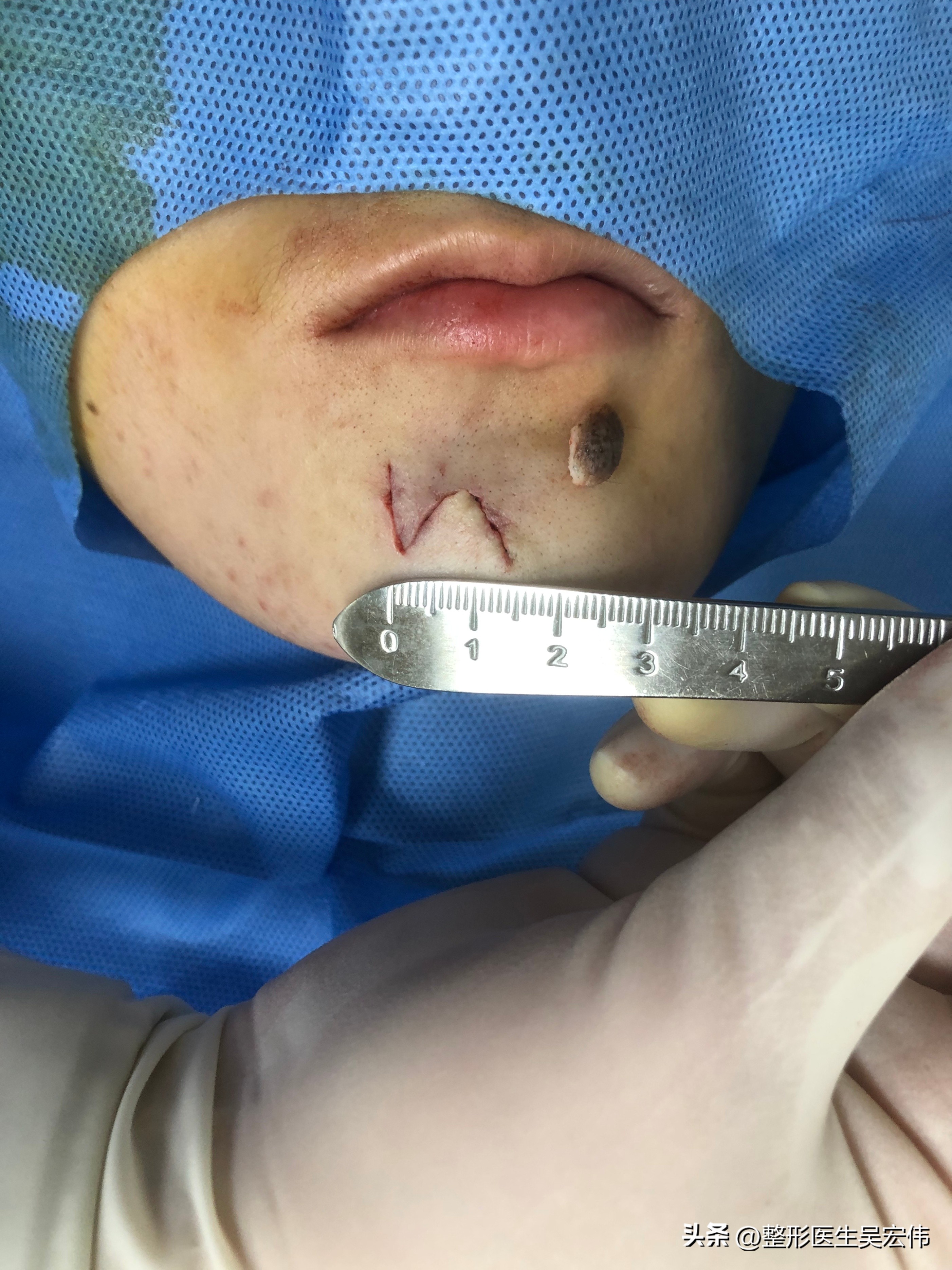 面部痣切除缝合不平整,面部痣可以去掉吗