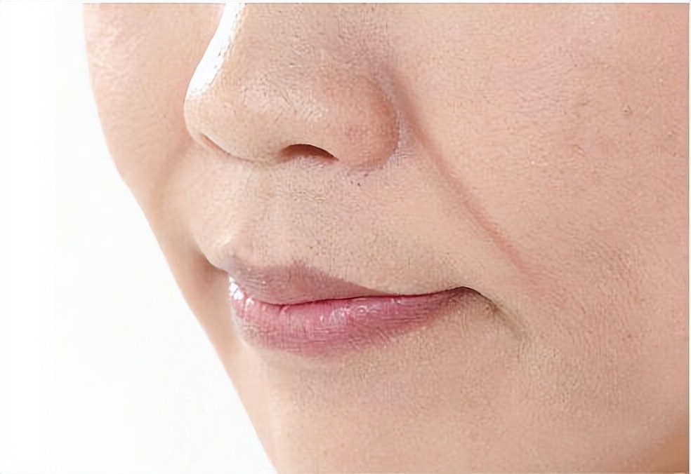 法令纹科普知识,刚刚玻尿酸填法令纹移位如何自救