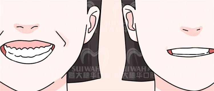 有一种“颜值杀手”叫露龈笑，这种情况该如何应对？