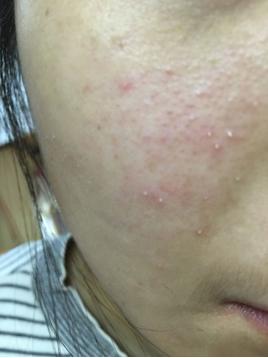 毛孔堵塞导致的爆痘应该怎么办,毛孔堵塞长痘图片