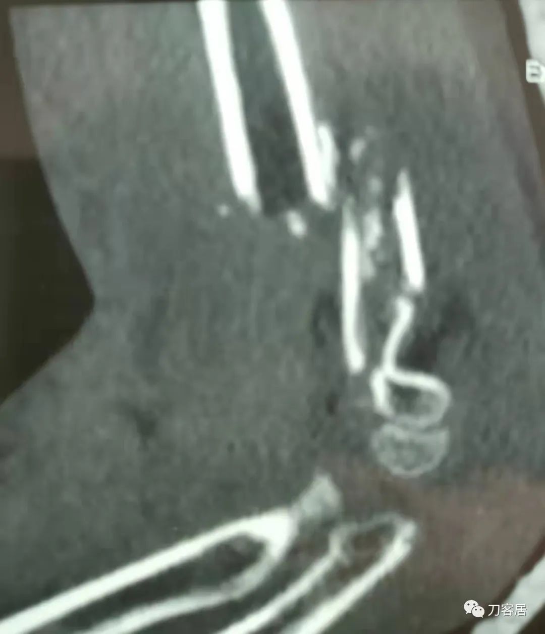 孩子胳膊摔伤肿了不能弯曲一直疼,9岁男孩摔倒手臂痛怎么办