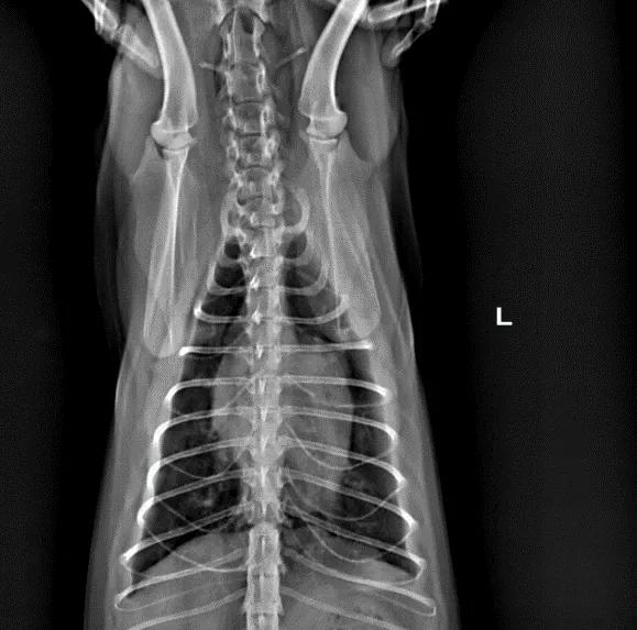 二尖瓣发育不良病例总结