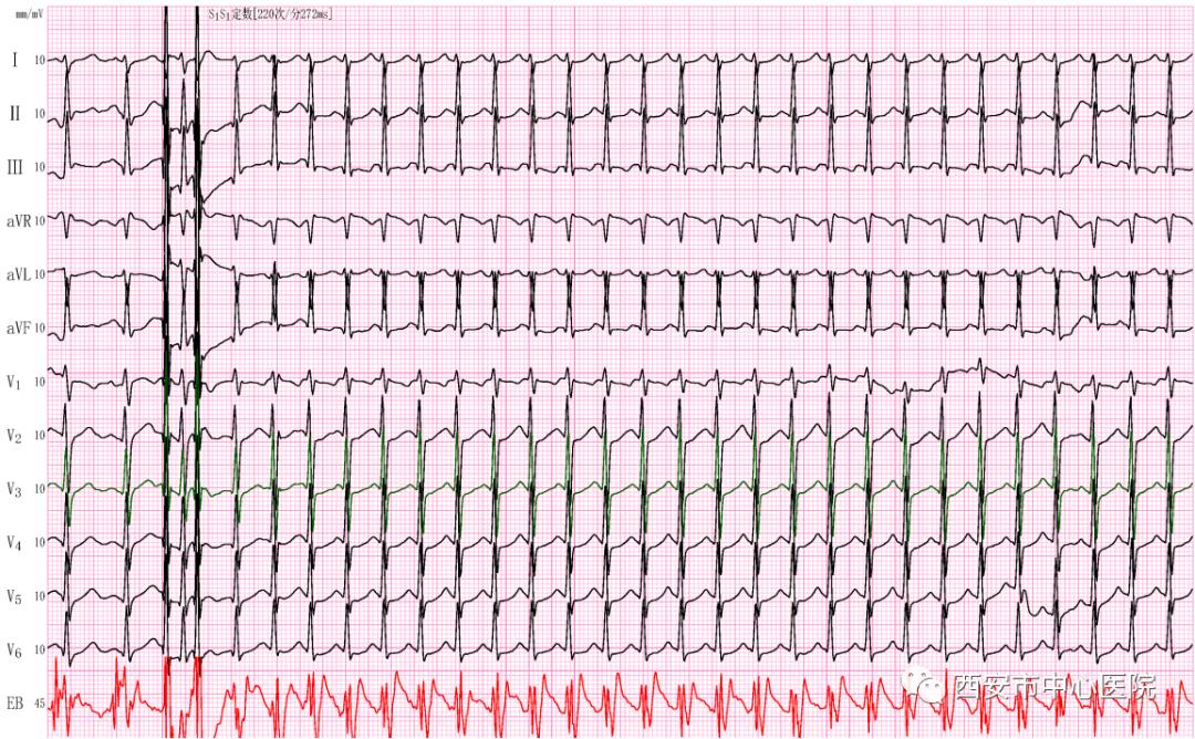 食道心电图正常可以排除什么疾病,食管内心电图和心脏调搏区别
