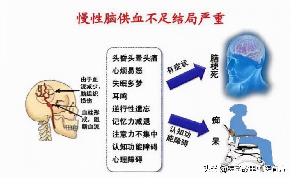 打通淤堵的中药方,疏通淤堵中药方