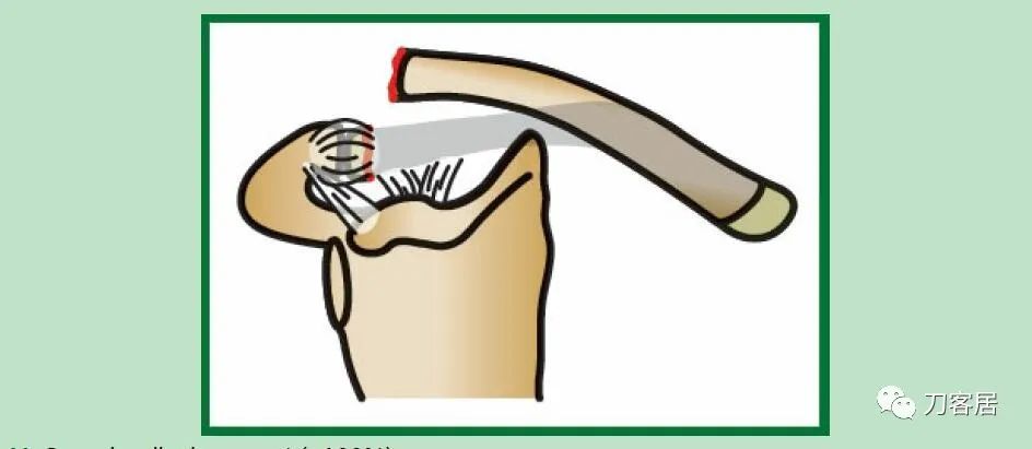 儿童锁骨骨折保守治疗的弊端,锁骨粉碎骨折错位不处理会愈合吗