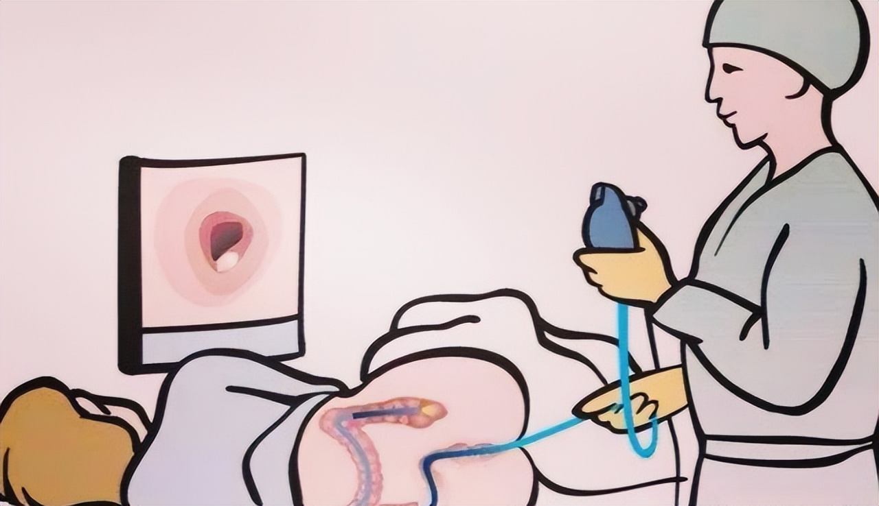 现在做肠镜和前几年做肠镜一样吗,肠镜正常一般几年做一次肠镜