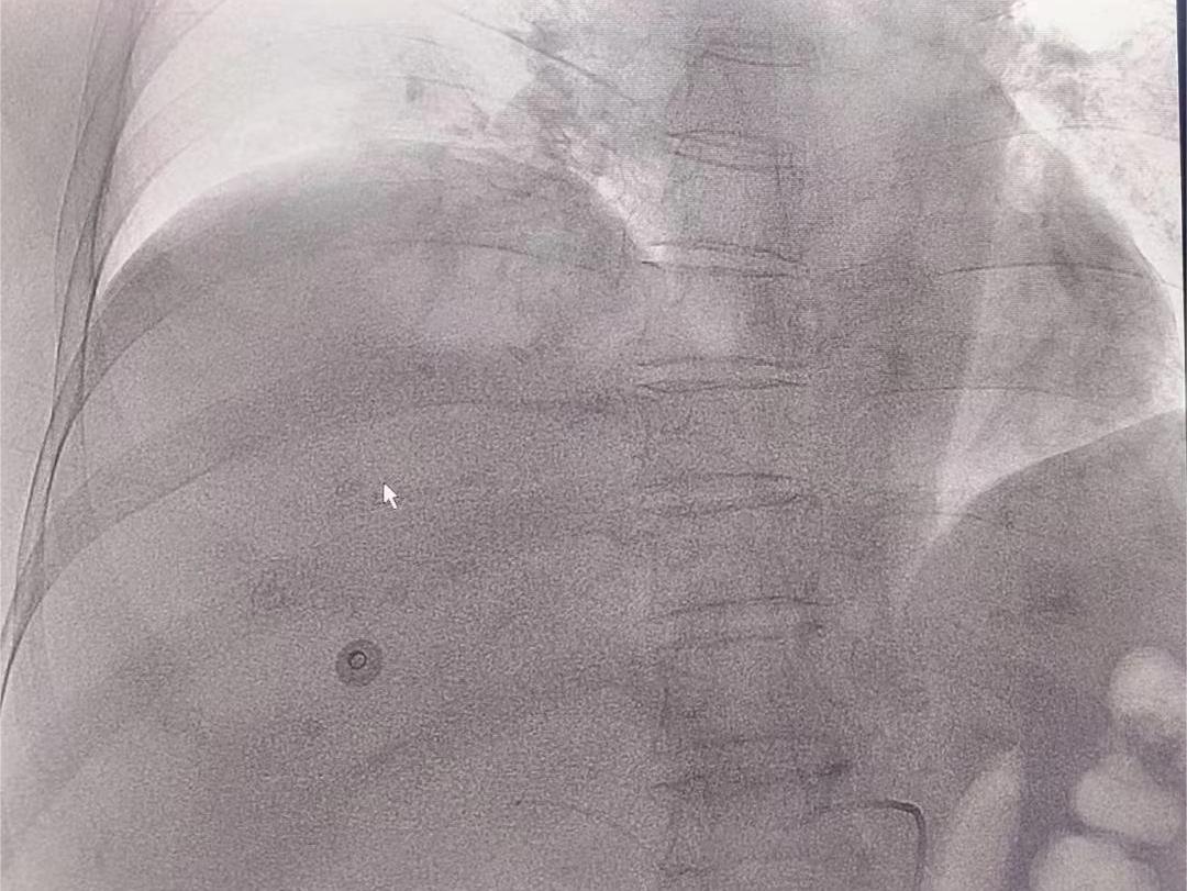 肝动脉灌注化疗治疗肝癌的并发症,肝癌肝动脉栓塞化疗