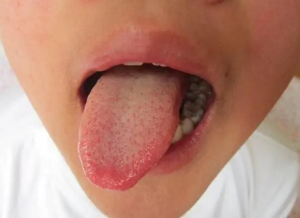 花椒可以去除湿气吗？提醒：平时多吃这“1物”，或能祛除湿气