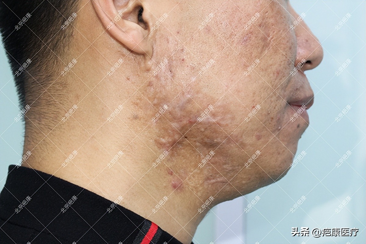 脸颊疤痕疙瘩治疗过程图,疤痕疙瘩脸颊