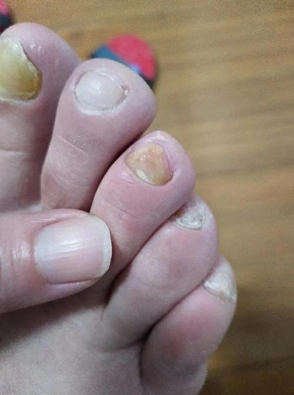 临汾十元根除灰指甲,拔掉灰指甲能根除吗